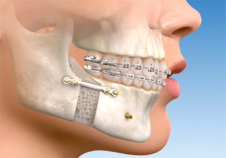 cirurgia-ortognatica-1
