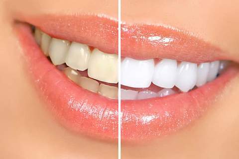 clareamento-dental-1